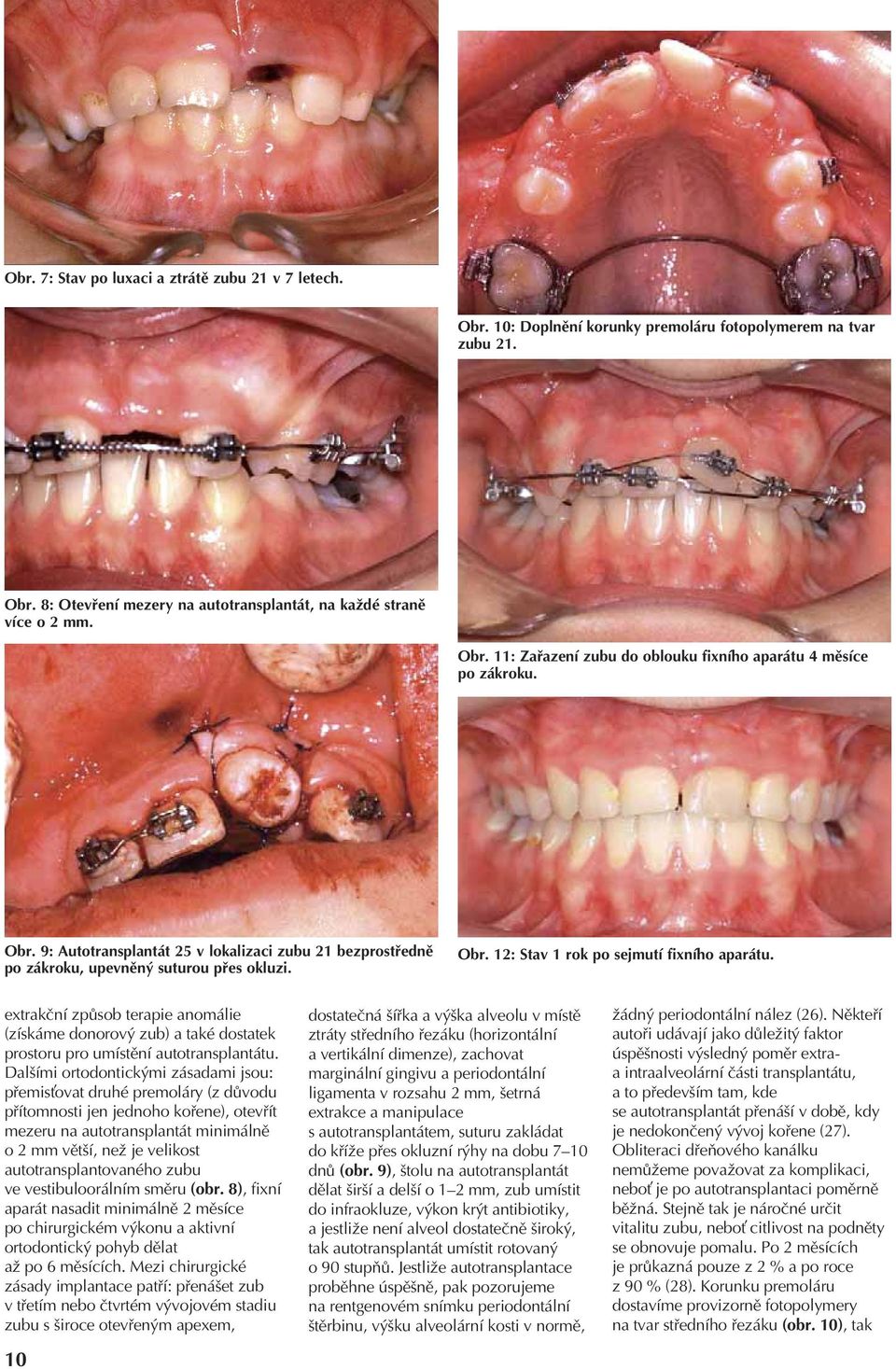 extrakční způsob terapie anomálie (získáme donorový zub) a také dostatek prostoru pro umístění autotransplantátu.