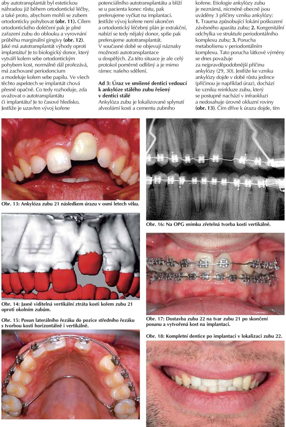 Je to biologický donor, který vytváří kolem sebe ortodontickým pohybem kost, normálně dál prořezává, má zachované periodoncium a modeluje kolem sebe papilu.