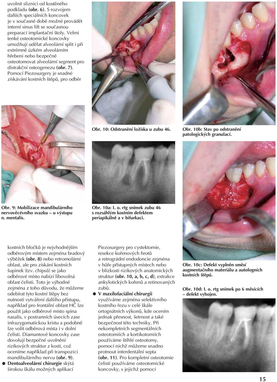 Pomocí Piezosurgery je snadné získávání kostních štěpů, pro odběr Obr. 10: Odstranění ložiska u zubu 46. Obr. 10b: Stav po odstranění patologických granulací. Obr. 9: Mobilizace mandibulárního nervověcévního svazku u výstupu n.