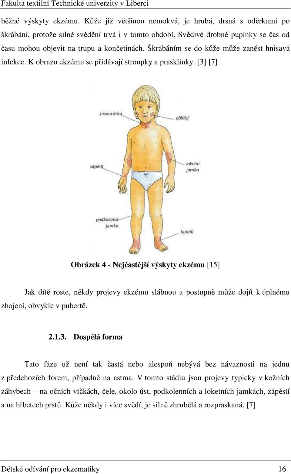 [3] [7] Obrázek 4 - Nejčastější výskyty ekzému [15] Jak dítě roste, někdy projevy ekzému slábnou a postupně může dojít k úplnému zhojení, obvykle v pubertě. 2.1.3. Dospělá forma Tato fáze už není tak častá nebo alespoň nebývá bez návaznosti na jednu z předchozích forem, případně na astma.