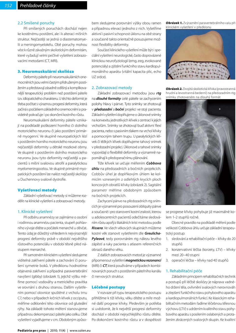 Neuromuskulární skolióza Deformity páteře při neuromuskulárních onemocněních jsou velmi častým přidruženým postižením a představují zásadně odlišný a komplikovanější terapeutický problém než