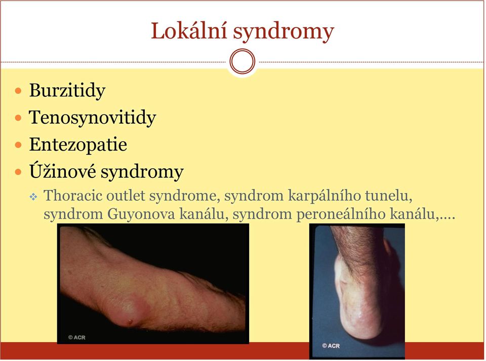 syndrome, syndrom karpálního tunelu, syndrom