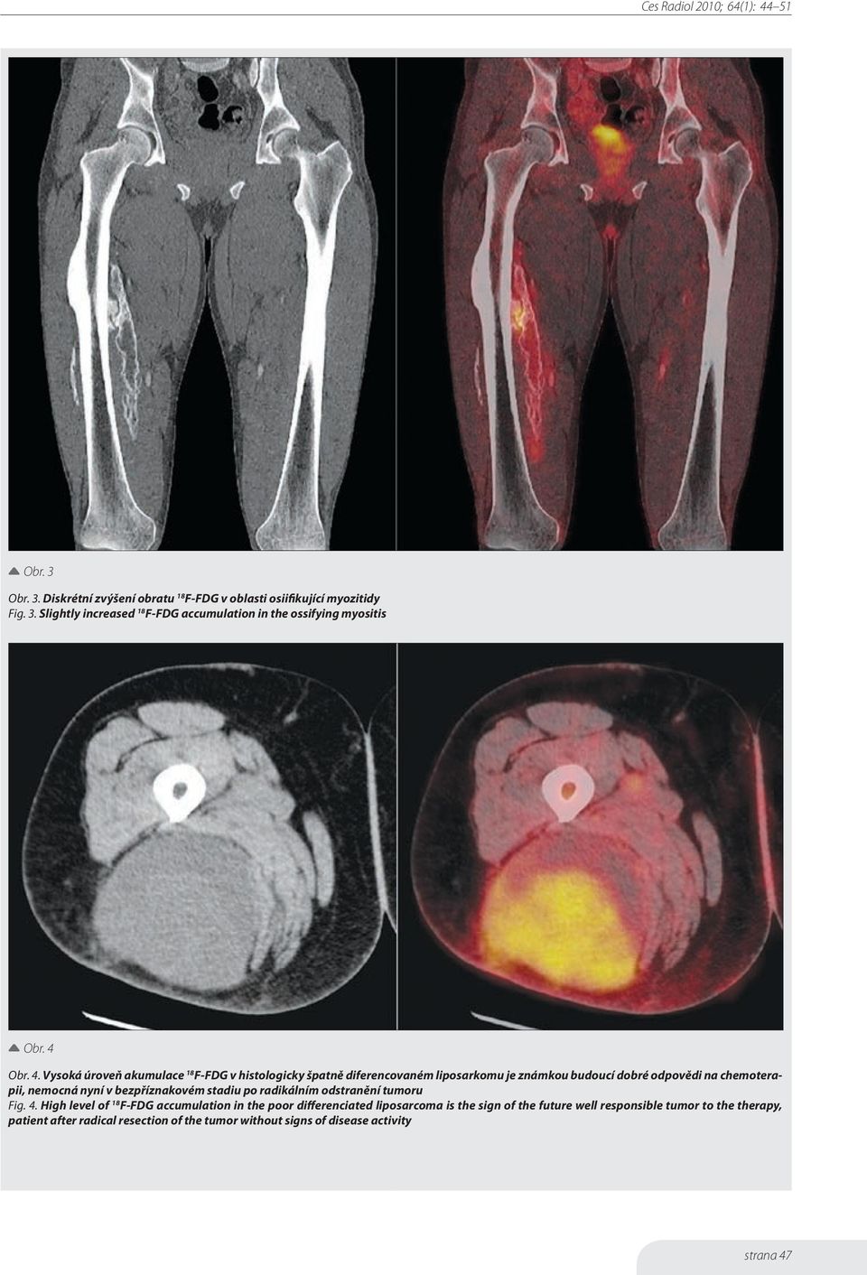 Vysoká úroveň akumulace 18 F-FDG v histologicky špatně diferencovaném liposarkomu je známkou budoucí dobré odpovědi na chemoterapii, nemocná nyní v