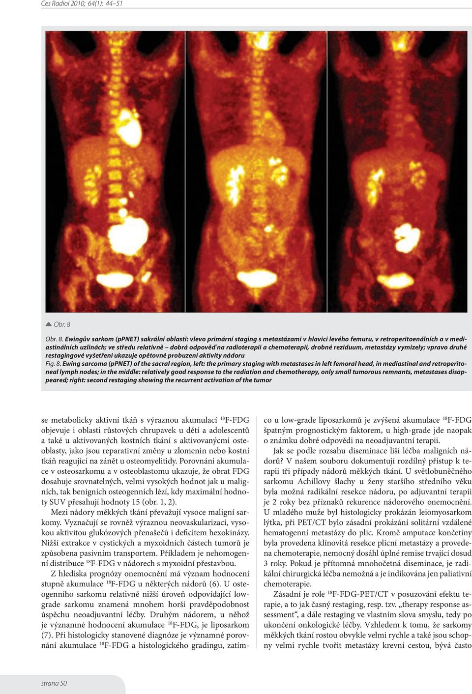 Ewingův sarkom (ppnet) sakrální oblasti: vlevo primární staging s metastázami v hlavici levého femuru, v retroperitoenálních a v mediastinálních uzlinách; ve středu relativně dobrá odpověď na