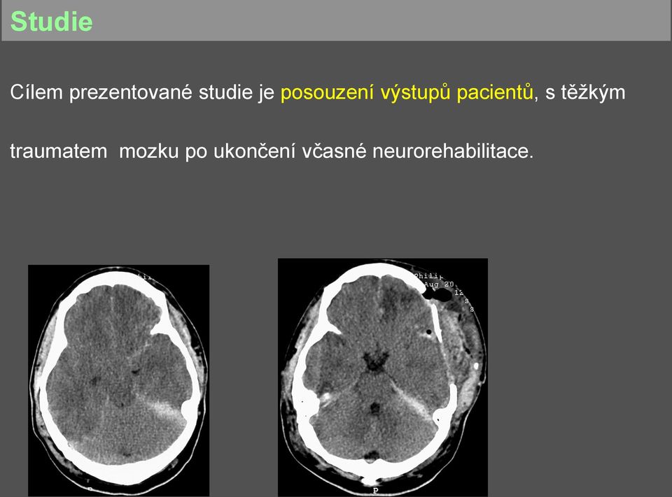 pacientů, s těžkým traumatem