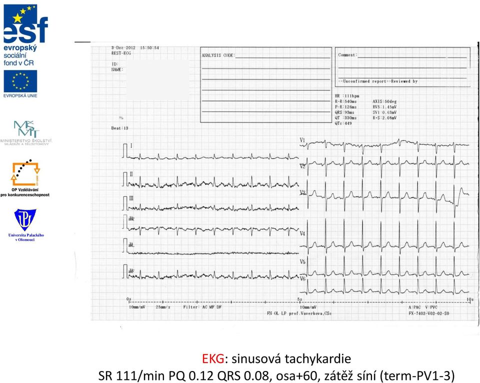 111/min PQ 0.12 QRS 0.