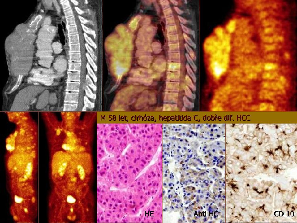 hepatitida C,