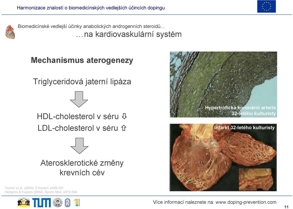 Hypertrofická koronární arterie 32-letého kulturisty Infarkt 32-letého kulturisty Aterosklerotické