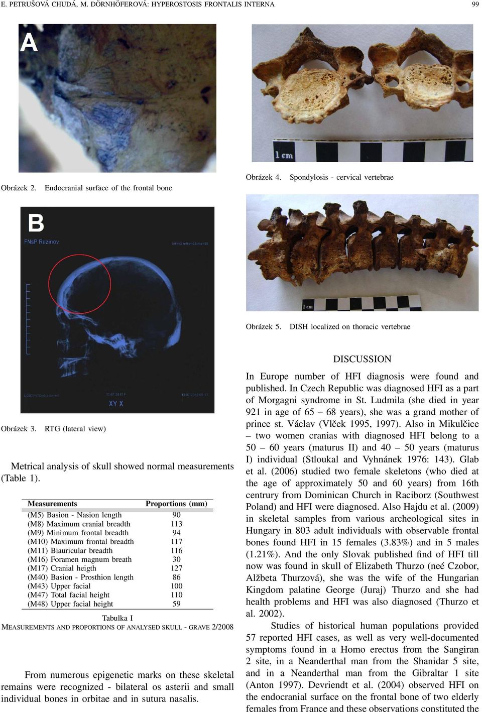 Measurements (M5) Basion - Nasion length (M8) Maximum cranial breadth (M9) Minimum frontal breadth (M10) Maximum frontal breadth (M11) Biauricular breadth (M16) Foramen magnum breath (M17) Cranial