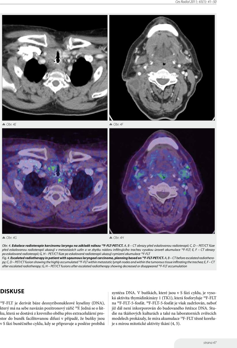 CT obrazy po eskalované radioterapii; G, H PET/CT fúze po eskalované radioterapii ukazují vymizení akumulace F-FLT Fig. 4.