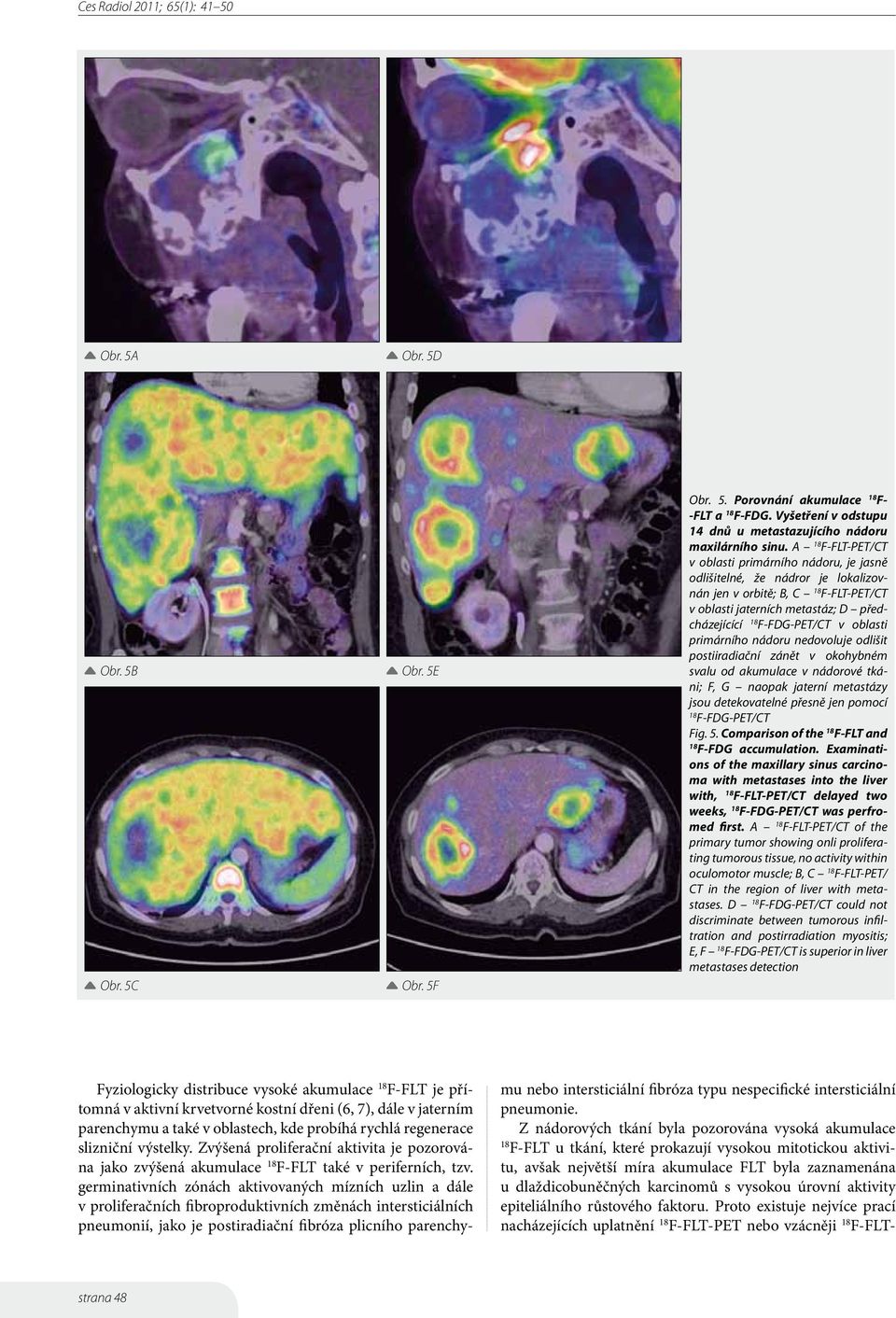 primárního nádoru nedovoluje odlišit postiiradiační zánět v okohybném svalu od akumulace v nádorové tkáni; F, G naopak jaterní metastázy jsou detekovatelné přesně jen pomocí F-FDG-PET/CT Fig. 5.