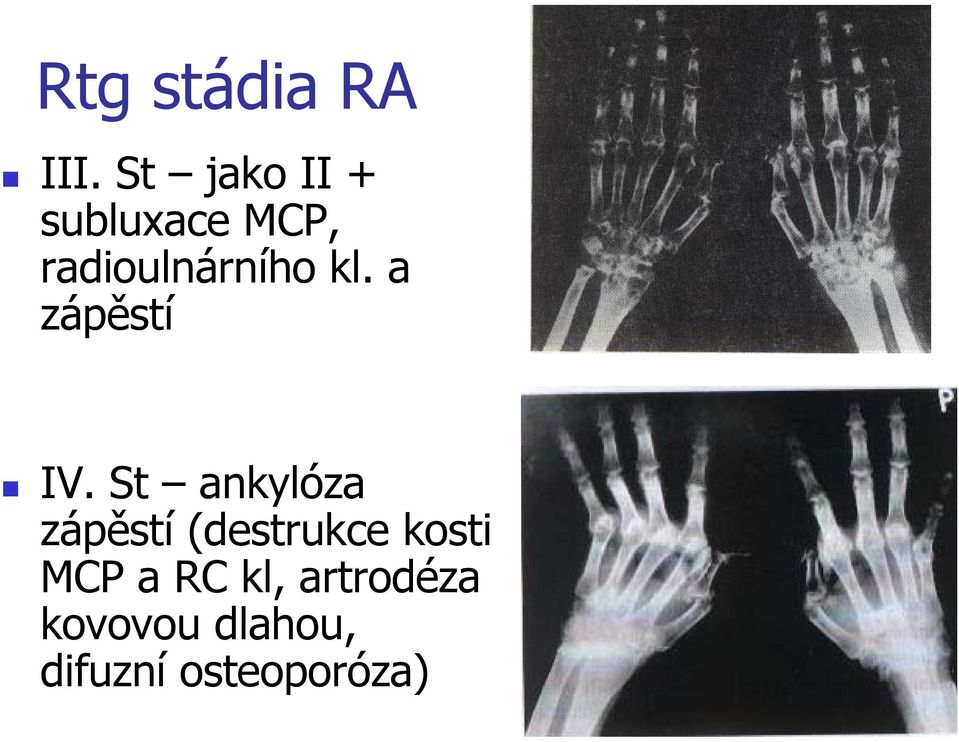 kl. a zápěstí IV.