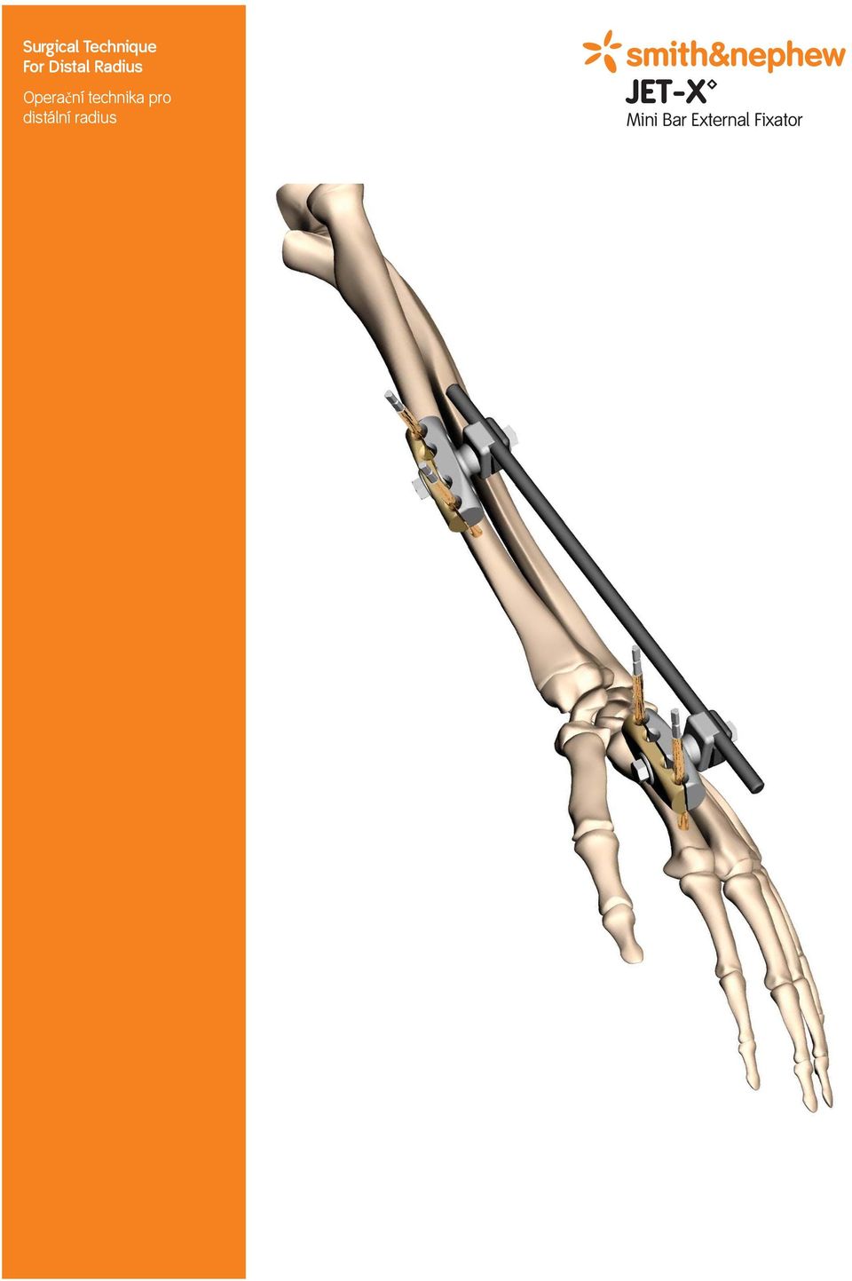 distální radius *smith&nephew