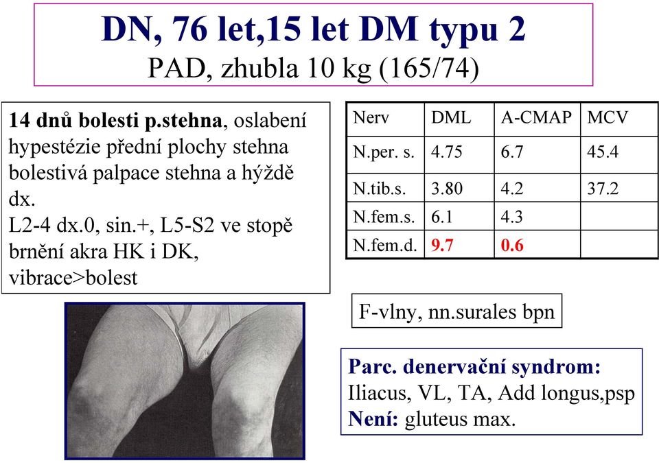 +, L5-S2 ve stopě brnění akra HK i DK, vibrace>bolest Nerv DML A-CMAP MCV N.per. s. 4.75 6.7 45.4 N.tib.s. 3.