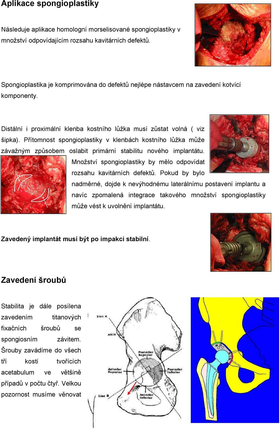 Přítomnost spongioplastiky v klenbách kostního lůžka může závažným způsobem oslabit primární stabilitu nového implantátu. Množství spongioplastiky by mělo odpovídat rozsahu kavitárních defektů.