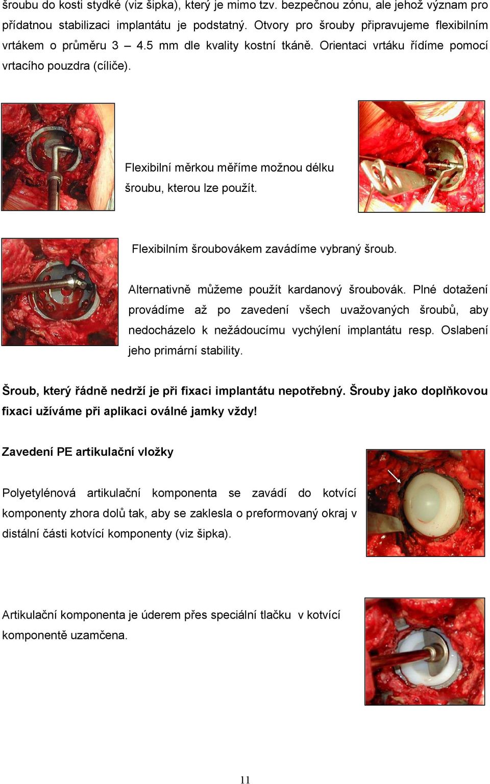 Flexibilní měrkou měříme možnou délku šroubu, kterou lze použít. Flexibilním šroubovákem zavádíme vybraný šroub. Alternativně můžeme použít kardanový šroubovák.