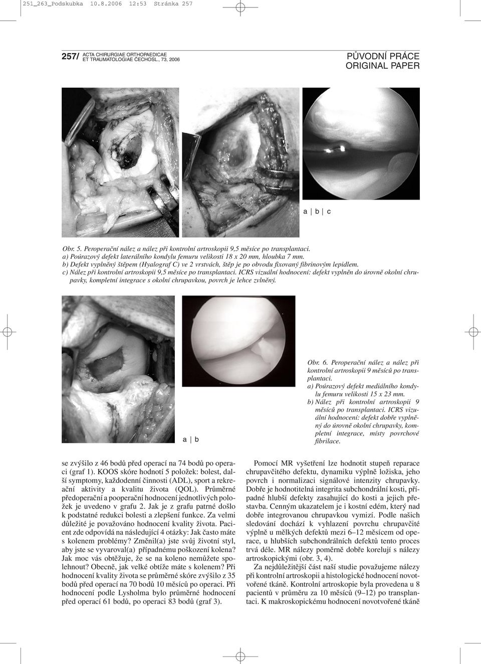 c) Nález při kontrolní artroskopii 9,5 měsíce po transplantaci. ICRS vizuální hodnocení: defekt vyplněn do úrovně okolní chrupavky, kompletní integrace s okolní chrupavkou, povrch je lehce zvlněný.