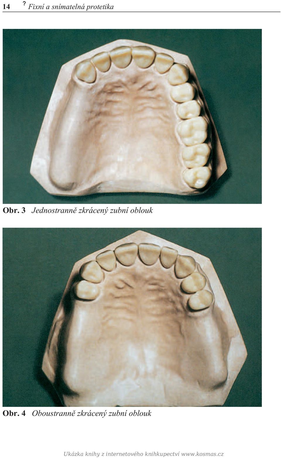 4 Oboustrannì zkrácený zubní oblouk Ukázka