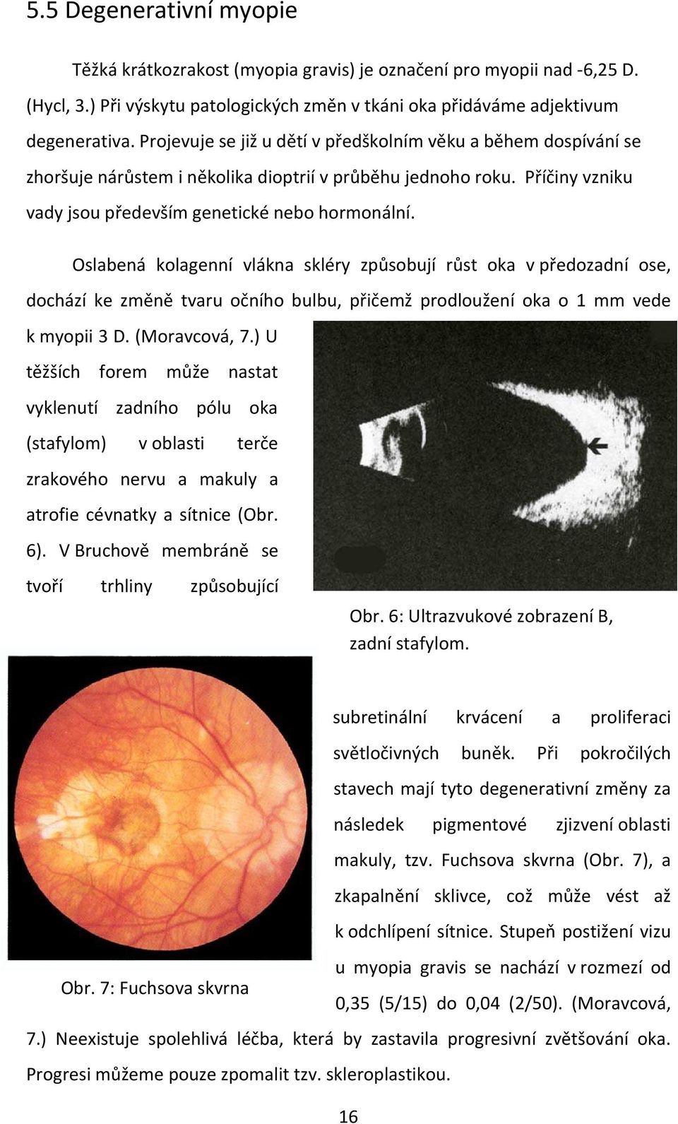 Oslabená kolagenní vlákna skléry způsobují růst oka v předozadní ose, dochází ke změně tvaru očního bulbu, přičemž prodloužení oka o 1 mm vede k myopii 3 D. (Moravcová, 7.