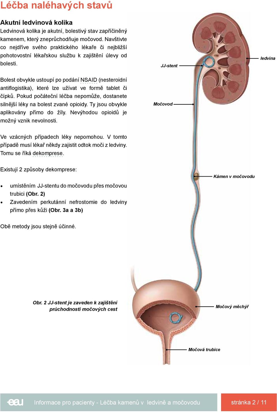 JJ-stent ledvina Bolest obvykle ustoupí po podání NSAID (nesteroidní antiflogistika), které lze užívat ve formě tablet či čípků.