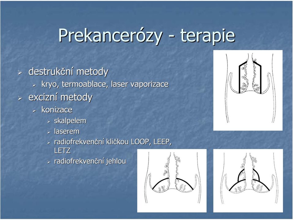 konizace skalpelem laserem radiofrekvenční