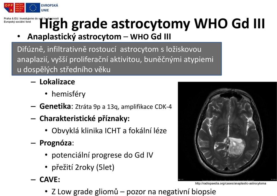 hemisféry Genetika: Ztráta 9p a 13q, amplifikace CDK-4 Charakteristické příznaky: Obvyklá klinika ICHT a fokální léze Prognóza: