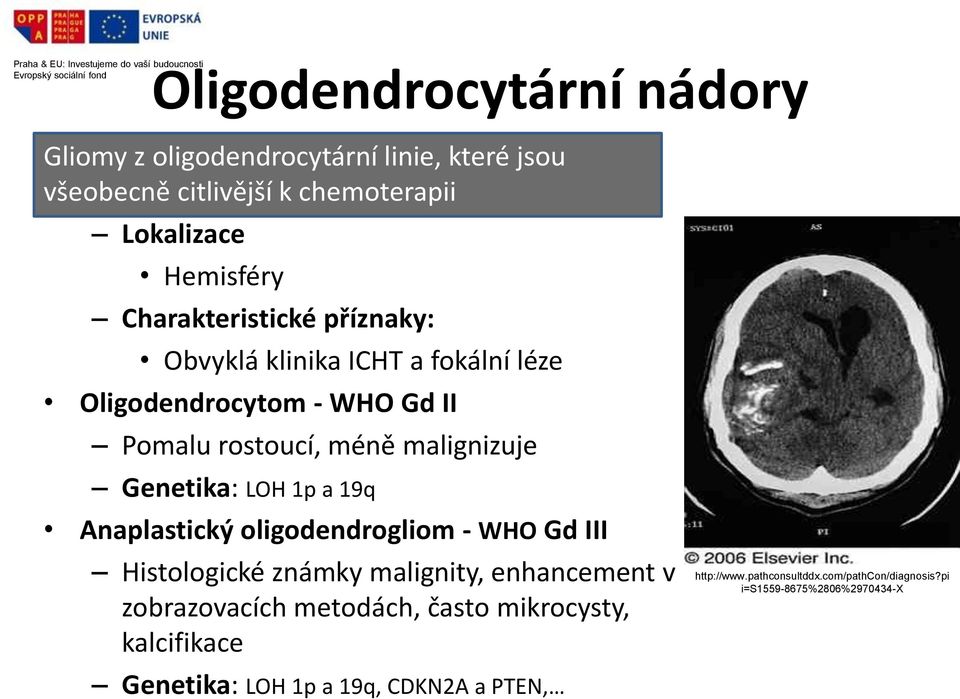 méně malignizuje Genetika: LOH 1p a 19q Anaplastický oligodendrogliom - WHO Gd III Histologické známky malignity, enhancement v zobrazovacích