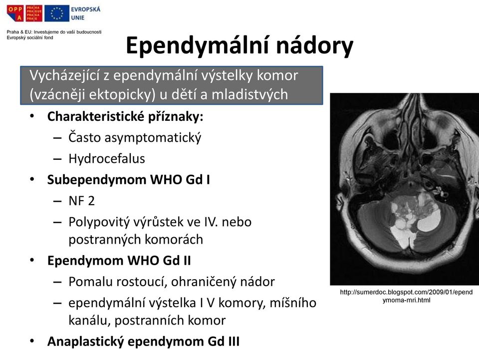 IV. nebo postranných komorách Ependymom WHO Gd II Pomalu rostoucí, ohraničený nádor ependymální výstelka I V