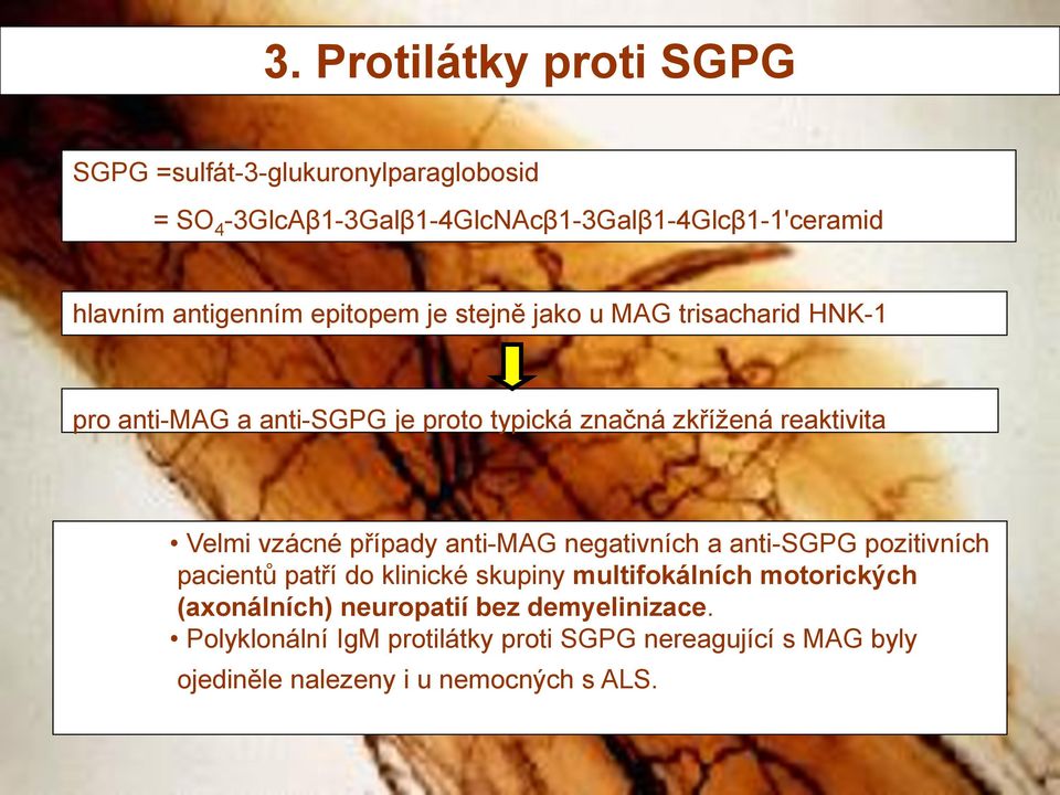 Velmi vzácné případy anti-mag negativních a anti-sgpg pozitivních pacientů patří do klinické skupiny multifokálních motorických