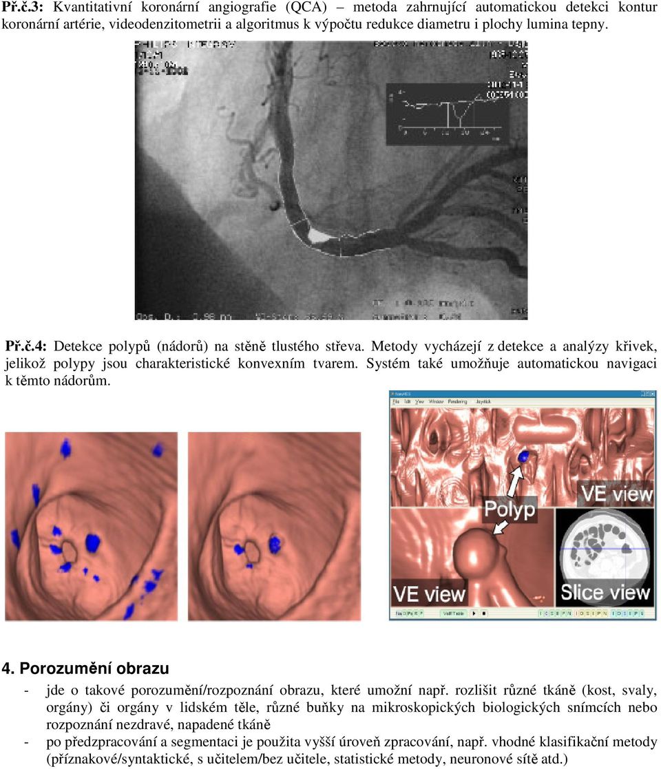 Systém také umožňuje automatickou navigaci k těmto nádorům. 4. Porozumění obrazu - jde o takové porozumění/rozpoznání obrazu, které umožní např.