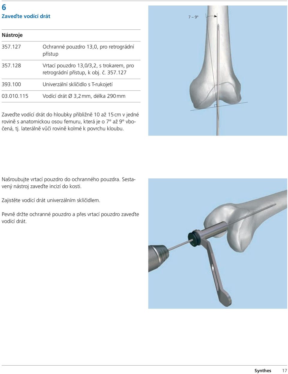 115 Vodící drát Ø 3,2 mm, délka 290 mm Zaveďte vodící drát do hloubky přibližně 10 až 15 cm v jedné rovině s anatomickou osou femuru, která je o 7 až 9 vbočená, tj.