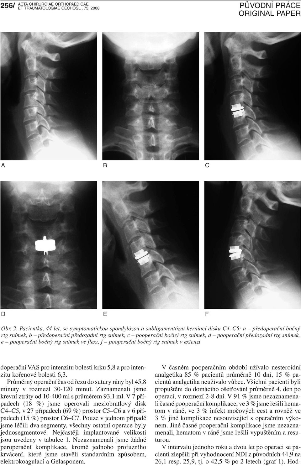 pooperační předozadní rtg snímek, e pooperační bočný rtg snímek ve flexi, f pooperační bočný rtg snímek v extenzi doperační VAS pro intenzitu bolesti krku 5,8 a pro intenzitu kořenové bolesti 6,3.