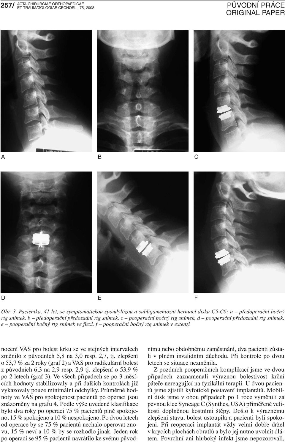 pooperační předozadní rtg snímek, e pooperační bočný rtg snímek ve flexi, f pooperační bočný rtg snímek v extenzi nocení VAS pro bolest krku se ve stejných intervalech změnilo z původních 5,8 na 3,0