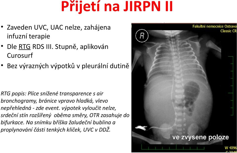 air bronchogramy, bránice vpravo hladká, vlevo nepřehledná - zde event.