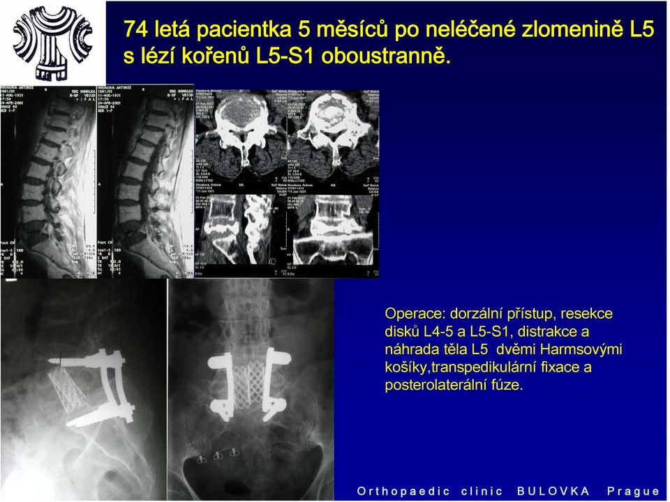 Operace: dorzální přístup, resekce disků L4-5 a L5-S1, distrakce a náhrada