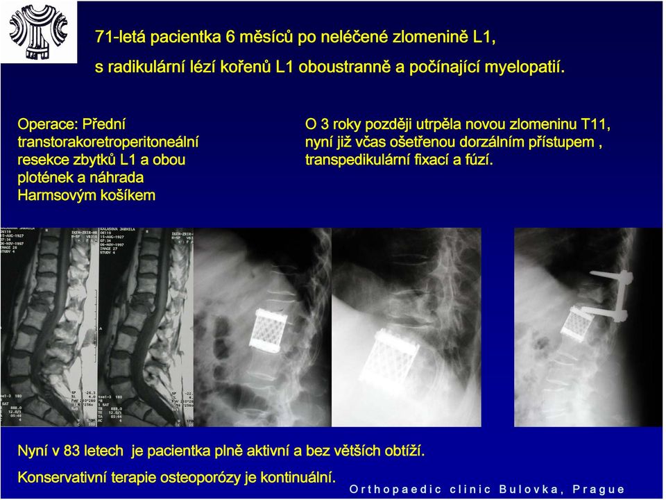 novou zlomeninu T11, nyní již včas ošetřenou dorzálním přístupem, transpedikulární fixací a fúzí.