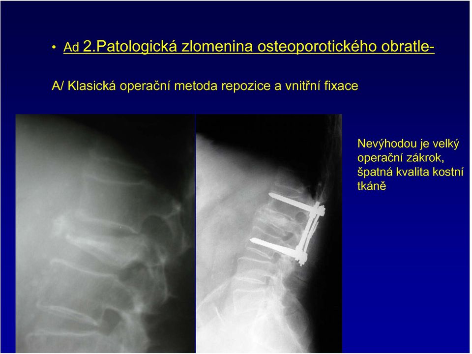 operační metoda repozice a vnitřní fixace