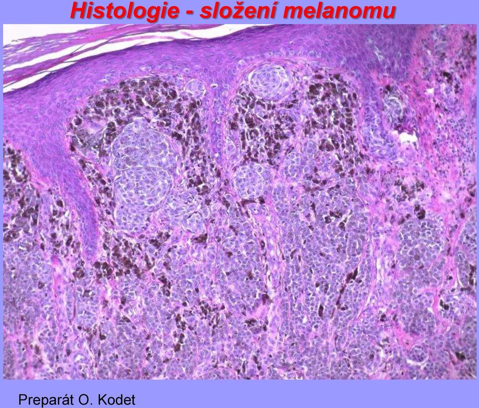 melanomu