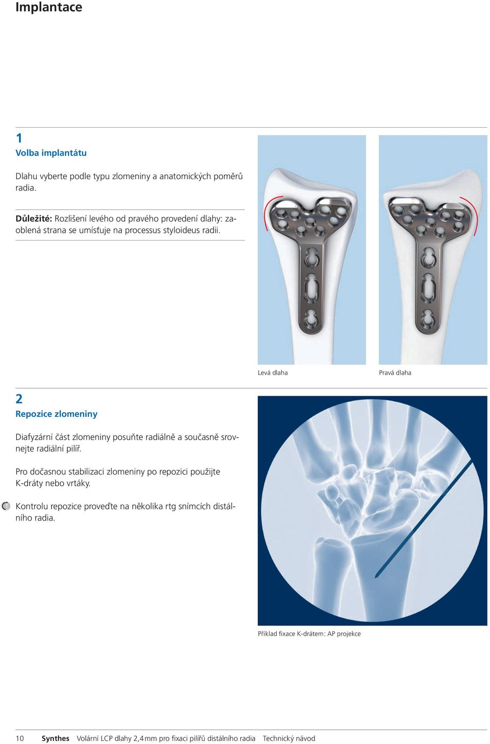 Levá dlaha Pravá dlaha 2 Repozice zlomeniny Diafyzární část zlomeniny posuňte radiálně a současně srovnejte radiální pilíř.
