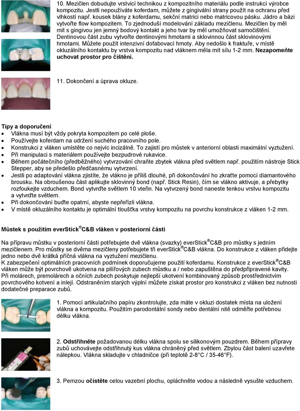 Mezičlen by měl mít s gingivou jen jemný bodový kontakt a jeho tvar by měl umožňovat samočištění. Dentinovou část zubu vytvořte dentinovými hmotami a sklovinnou část sklovinovými hmotami.