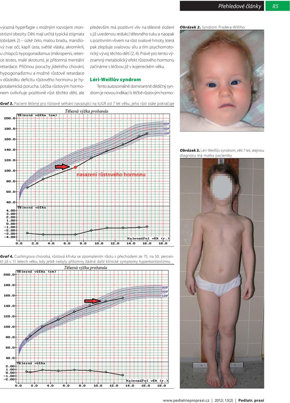 přítomná mentální retardace. Příčinou poruchy jídelního chování, hypogonadizmu a možné růstové retardace v důsledku deficitu růstového hormonu je hypotalamická porucha.