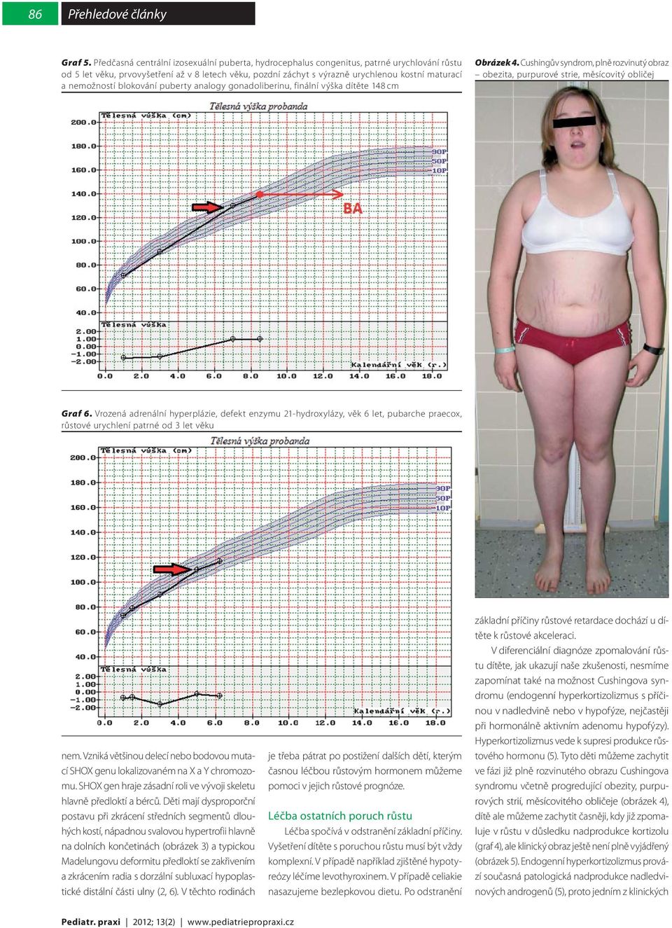 nemožností blokování puberty analogy gonadoliberinu, finální výška dítěte 148 cm Obrázek 4. Cushingův syndrom, plně rozvinutý obraz obezita, purpurové strie, měsícovitý obličej Graf 6.