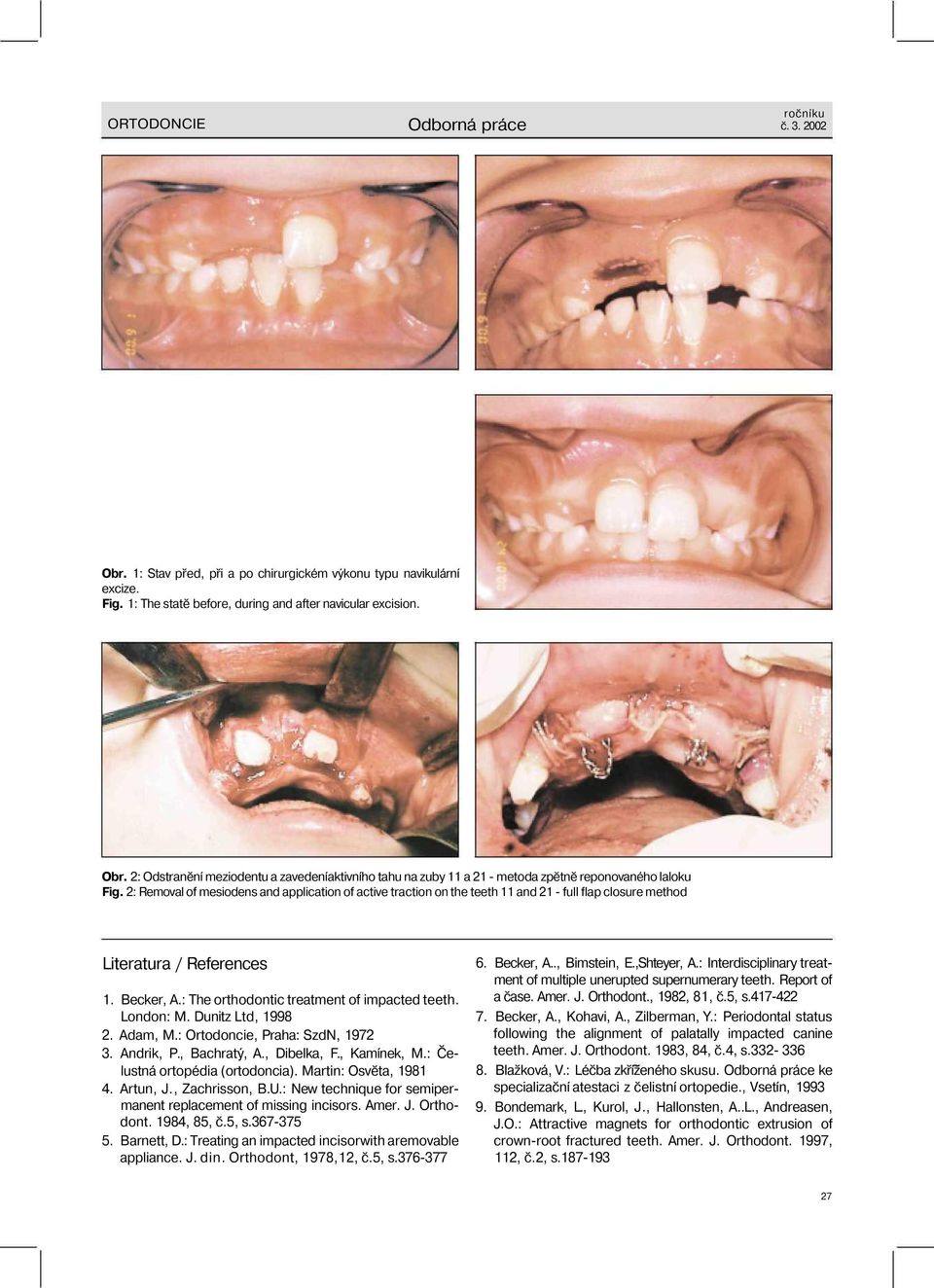 London: M. Dunitz Ltd, 1998 2. Adam, M.: Ortodoncie, Praha: SzdN, 1972 3. Andrik, P., Bachratý, A., Dibelka, F., Kamínek, M.: Čelustná ortopédia (ortodoncia). Martin: Osvěta, 1981 4. Artun, J.