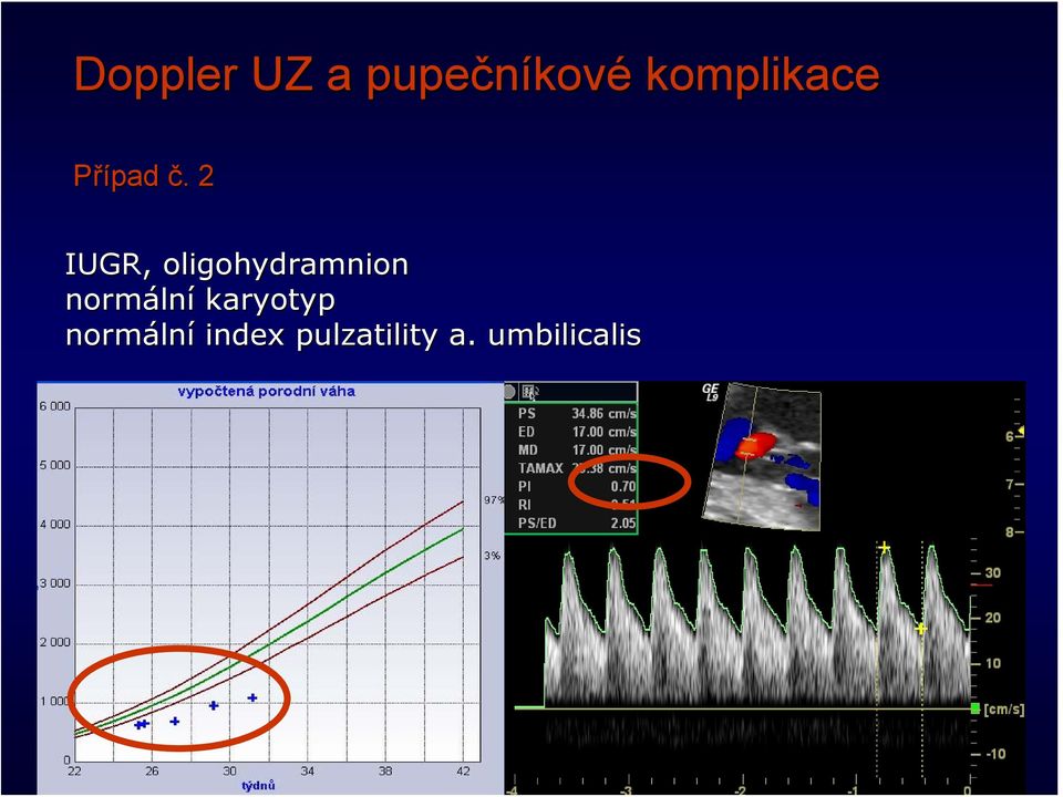 . 2 IUGR, oligohydramnion normáln