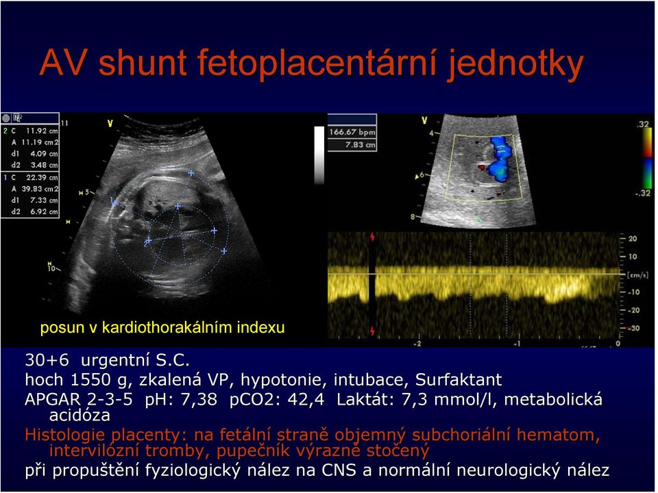 mmol/l, metabolická acidóza Histologie placenty: na fetáln lní straně objemný subchoriáln lní hematom,