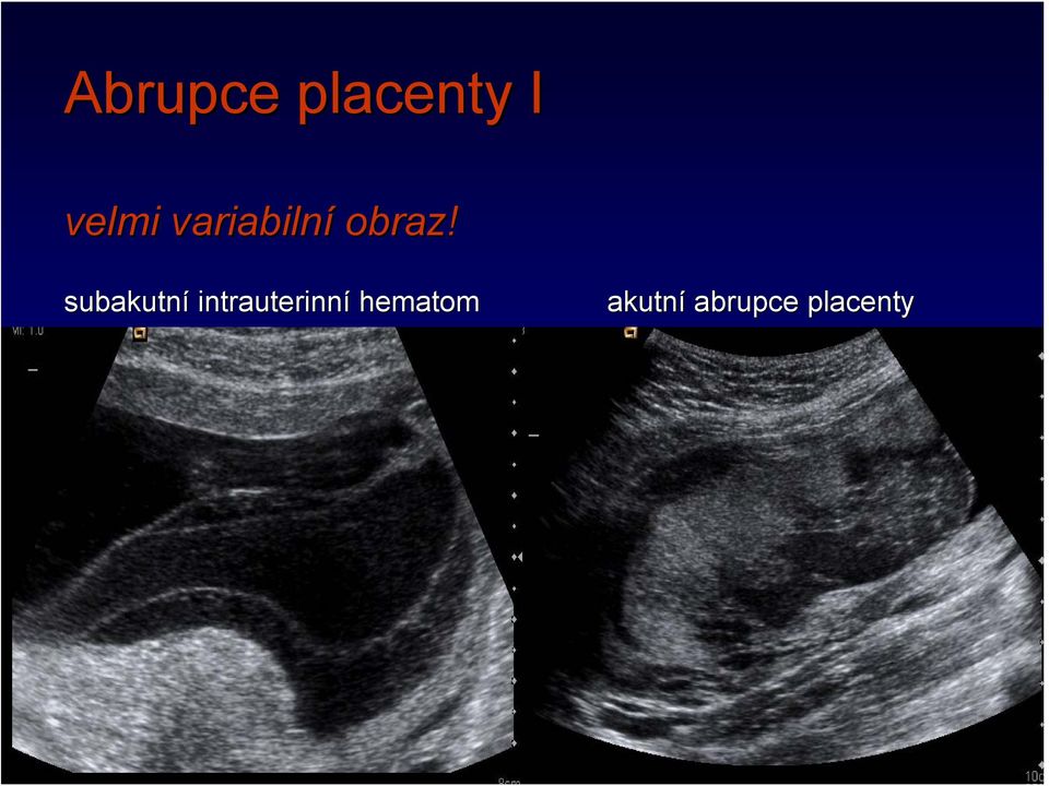 subakutní intrauterinní