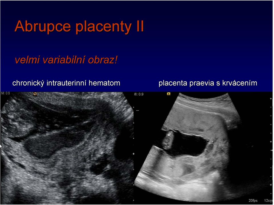 chronický intrauterinní