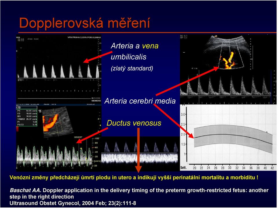 indikují vyšší perinatáln lní mortalitu a morbiditu! Baschat AA.