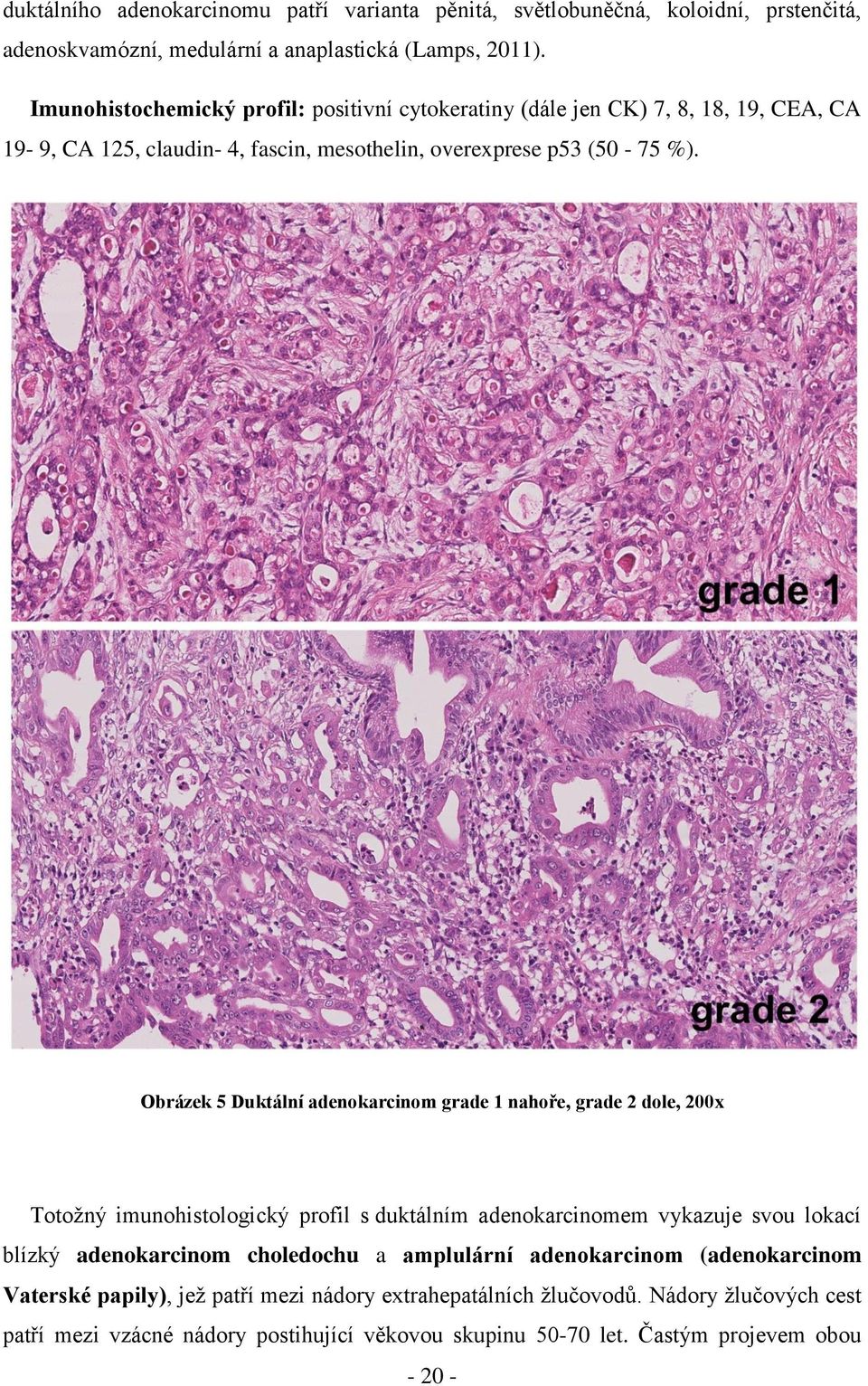 Obrázek 5 Duktální adenokarcinom grade 1 nahoře, grade 2 dole, 200x Totožný imunohistologický profil s duktálním adenokarcinomem vykazuje svou lokací blízký adenokarcinom