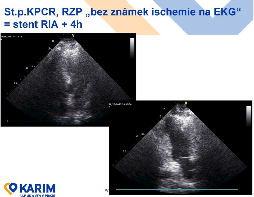 ischemie na EKG